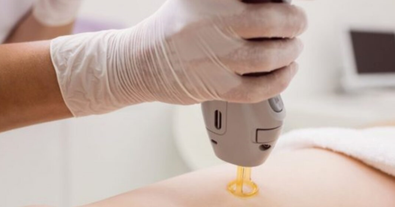 Häufig gestellte Fragen zur Laser-Haarentfernung
