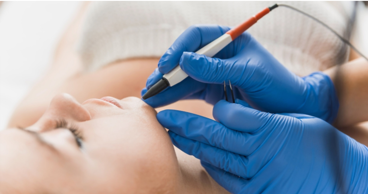 Wie lange dauert die Elektrolyse? Wie viele Sitzungen sind nötig?