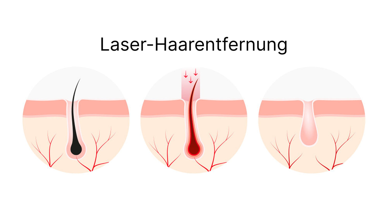 IPL-Haarentfernung