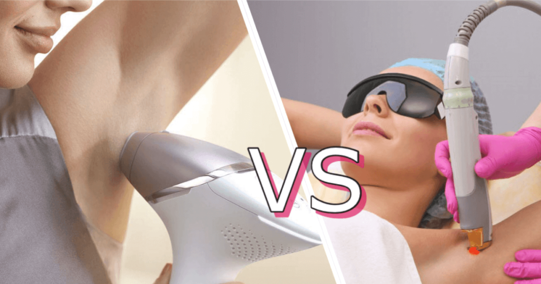 Laser-Haarentfernung zu Hause vs. im Salon