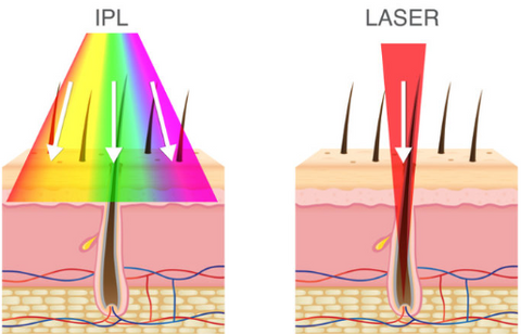 Was ist IPL-Haarentfernung?