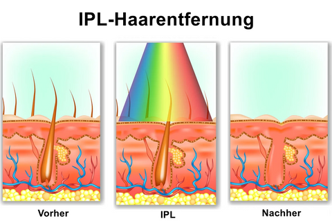 IPL-Haarentfernung Ulike