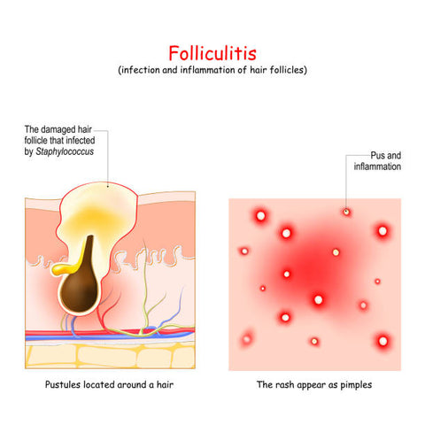 Follikulitis