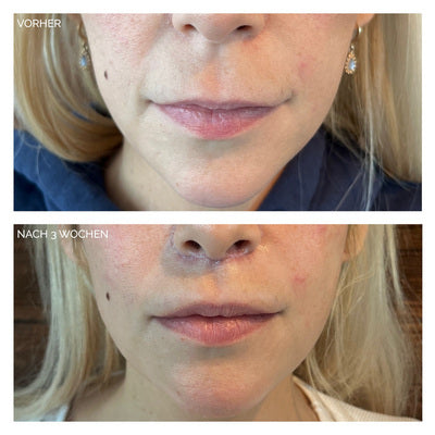 Fadenziehen der Oberlippe vorher und nachher